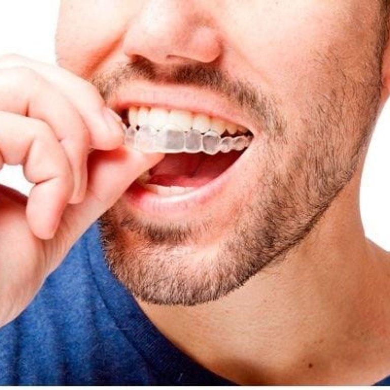 Aparatul dentar invizibil Invisalign