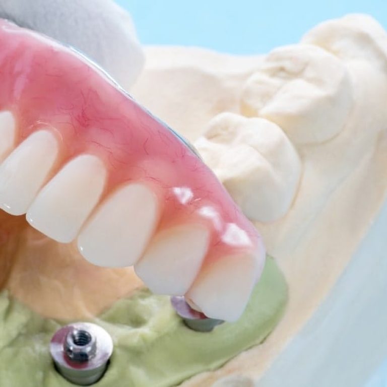 Protetica fixă – preturi - Miko Dental