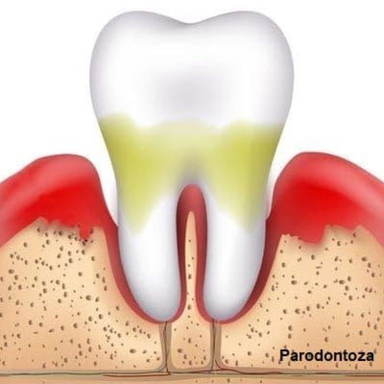Parodontoza: ce este, care sunt cauzele si cum se trateaza