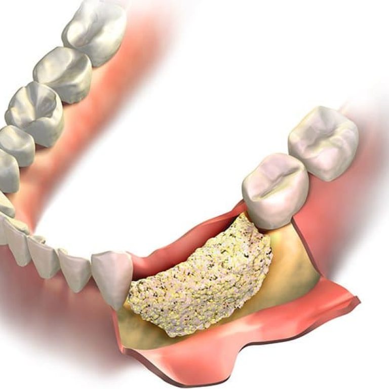 Aditie si augmentare osoasa