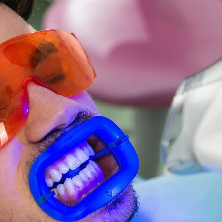 Cum-se-realizeaza-albirea-dintilor