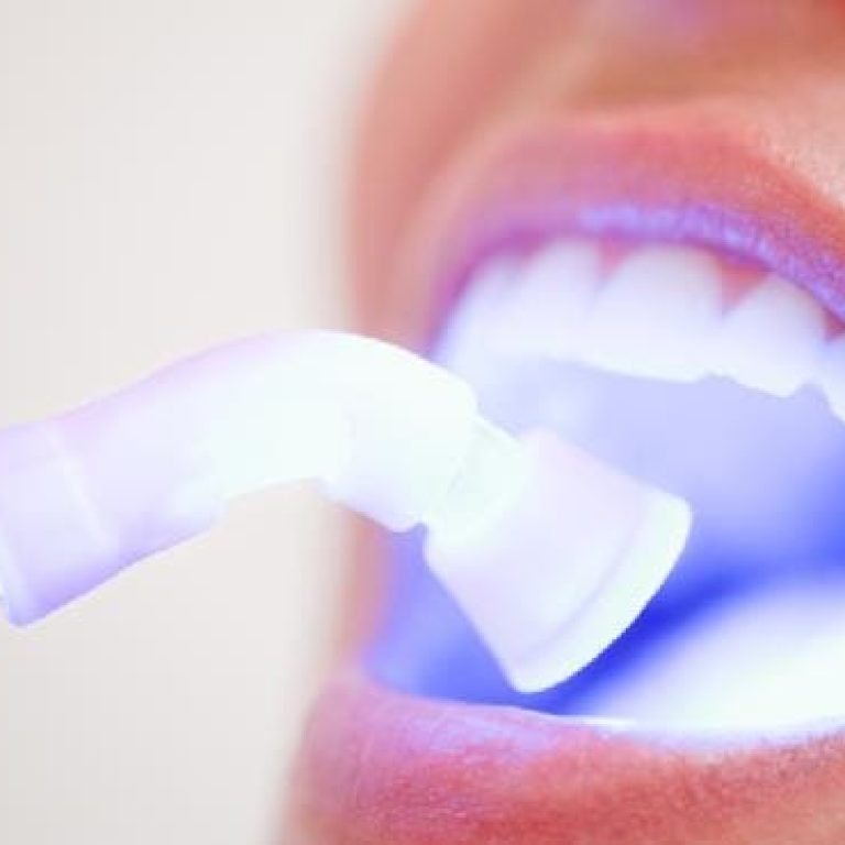 albire dinti cu laser bucuresti