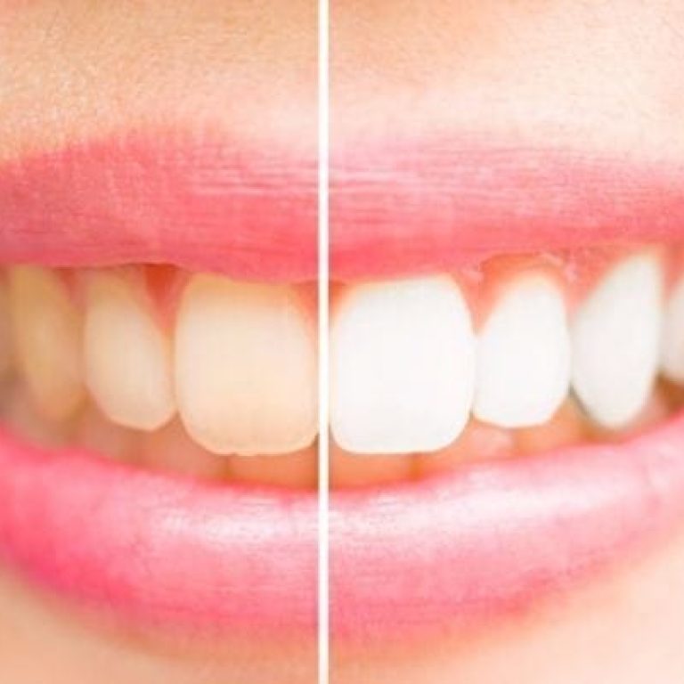 Albirea profesionala a dintilor