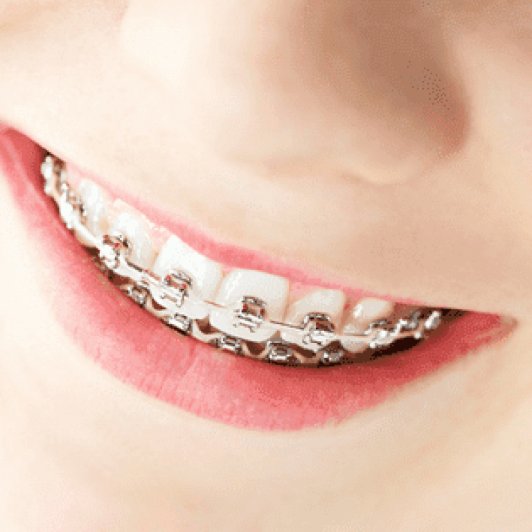 aparate dentare copii