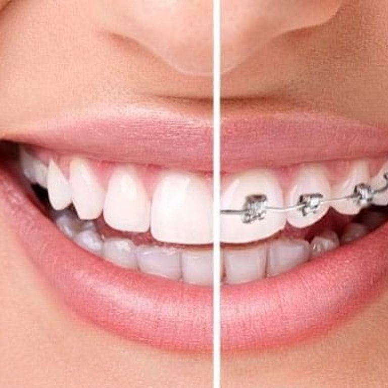 Aparat dentar safir invizibil