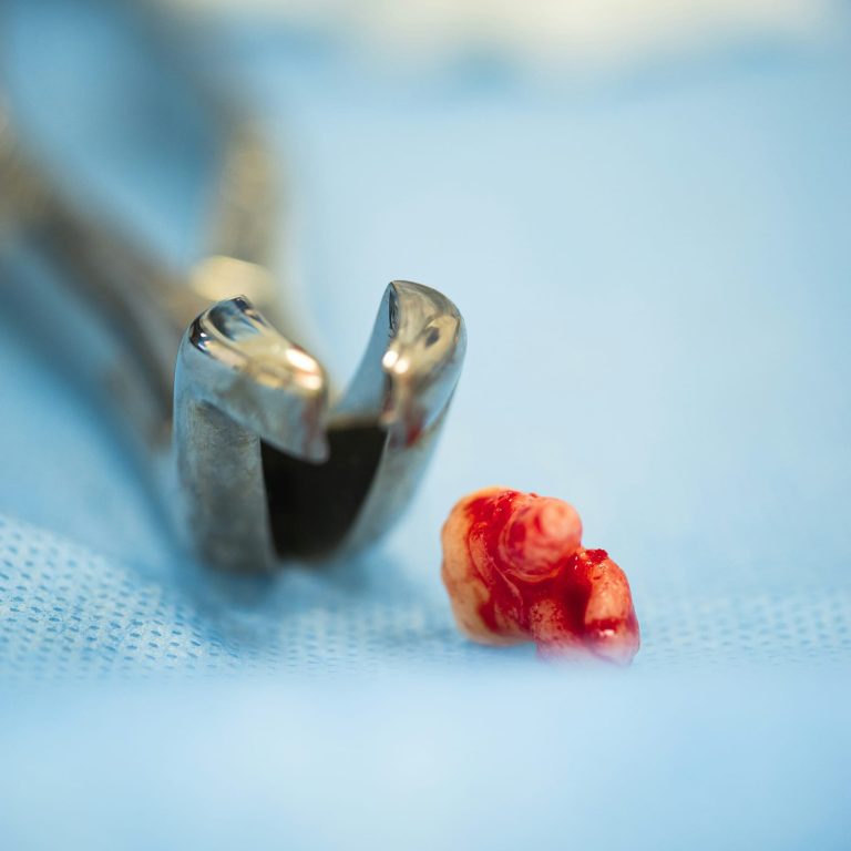 Recuperarea dupa extractia unei masele – ce poti manca si cum te ingrijesti - Miko Dental