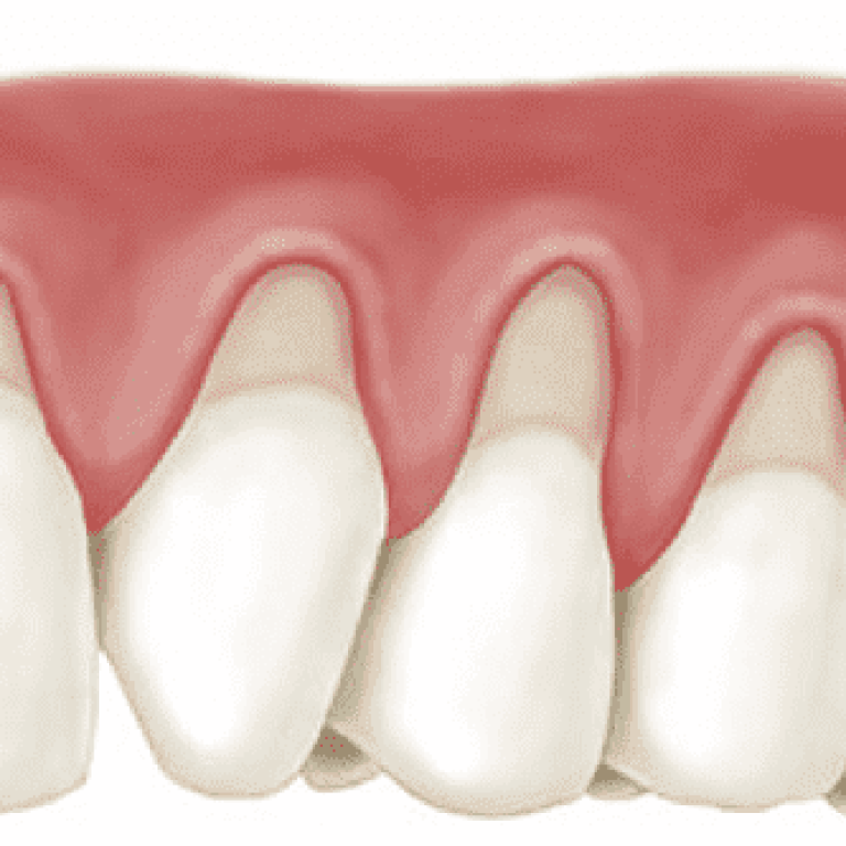 carie colet cauze tratament