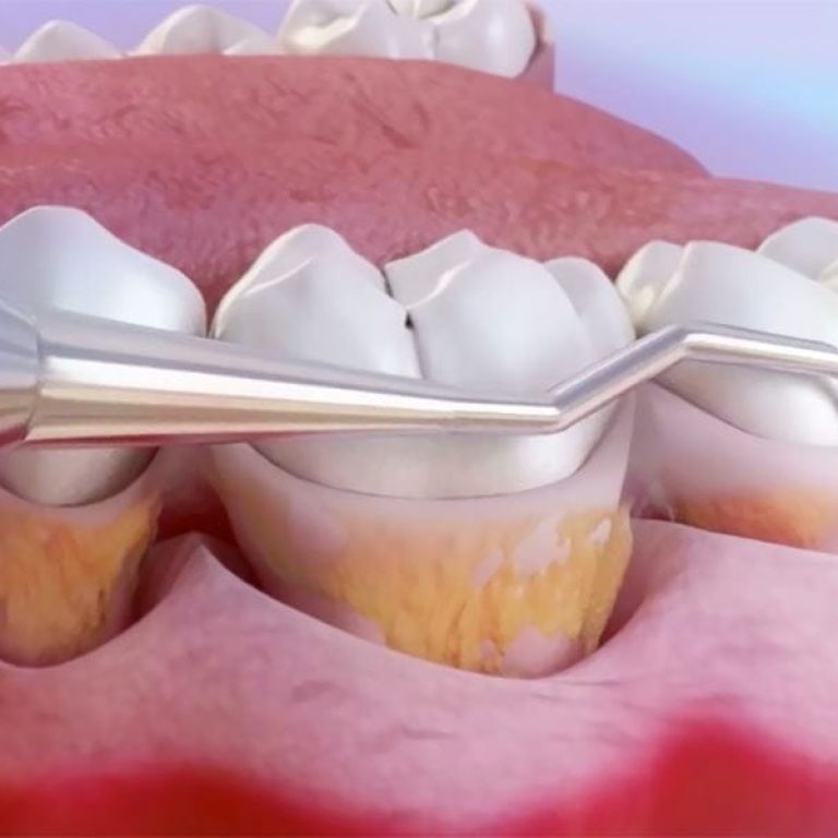 Chiuretajul subgingival și detartrajul în tratarea parodontitei