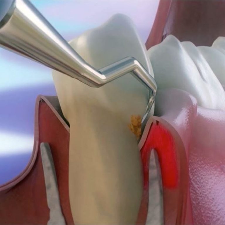 Chiuretajul subgingival și detartrajul în tratarea parodontitei
