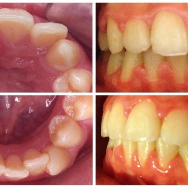 aparat dentar tratament ortodontic