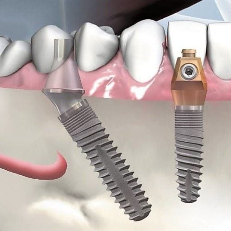 Implant dentar Bredent