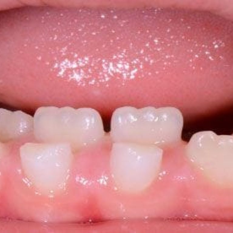 Dinti supranumerari copii