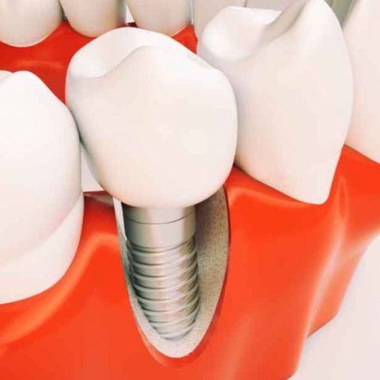 durata viata implant dentar