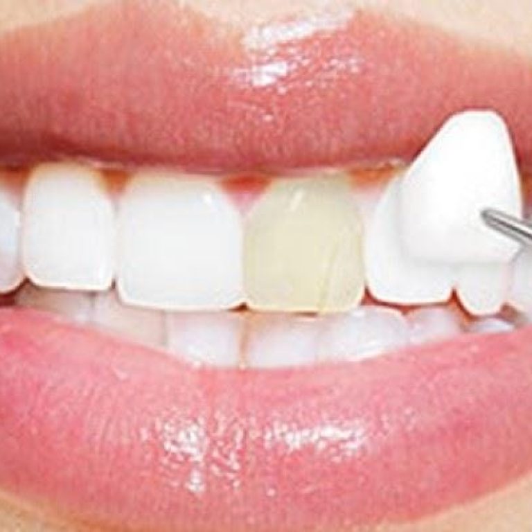 fetete-dentare-sau-coroane