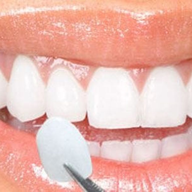 fatete dentare bucuresti