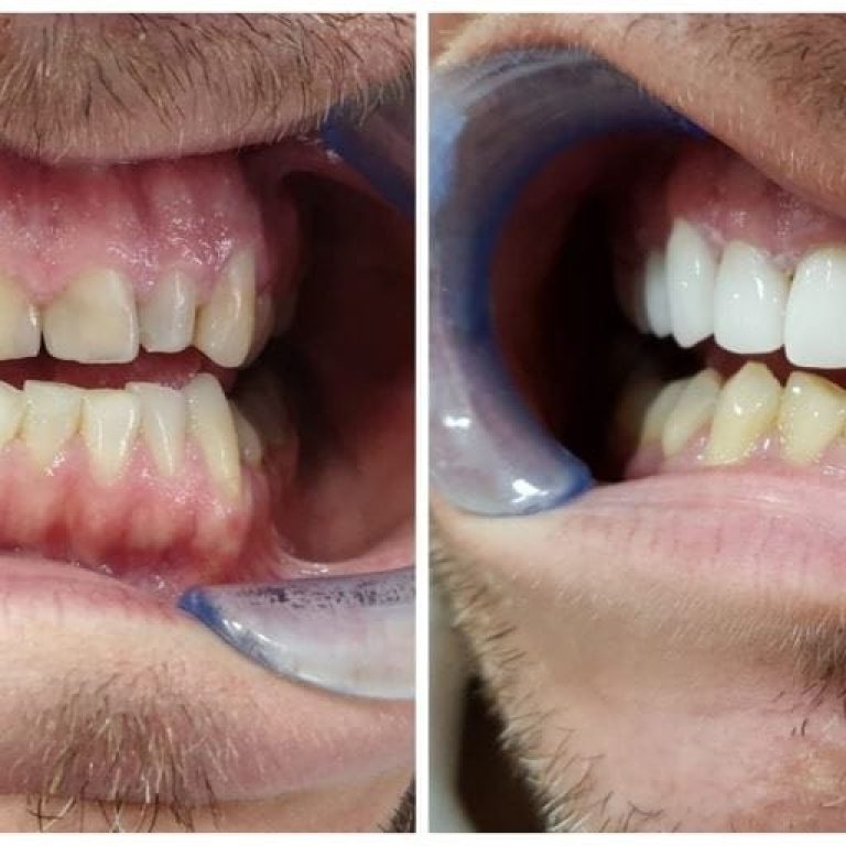 fatete-dentare-miko-2-1024×512