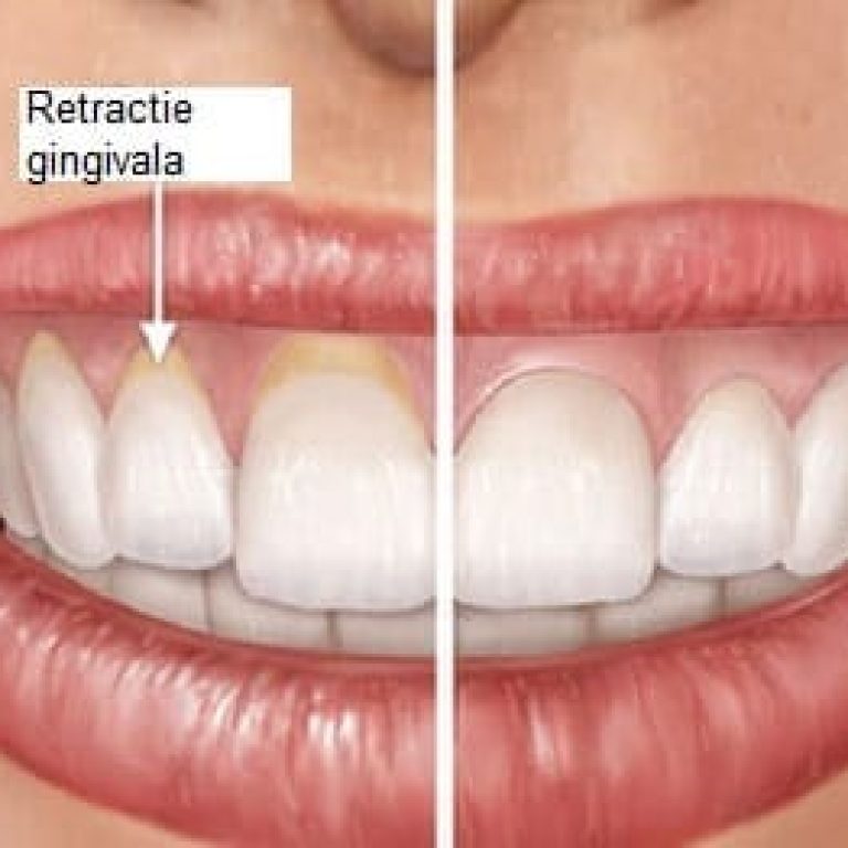 Remodelarea gingivala