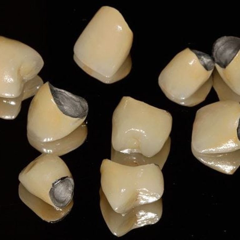implant-coroana-metalo-ceramica