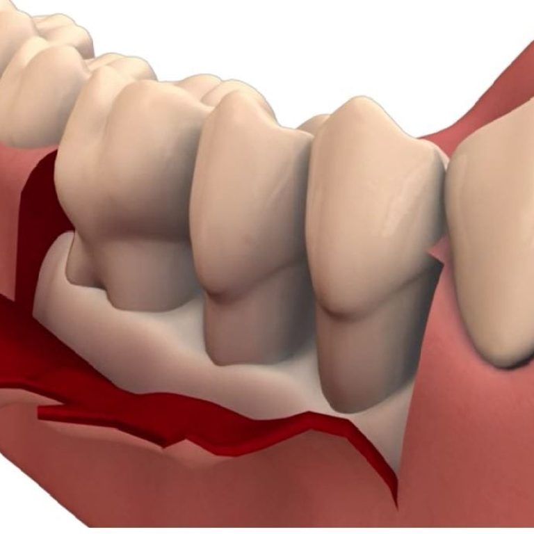 Operatia cu lambou in tratamentul parodontozei
