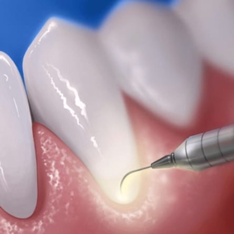 Laserul in parodontologie - tratamentul parodontozei