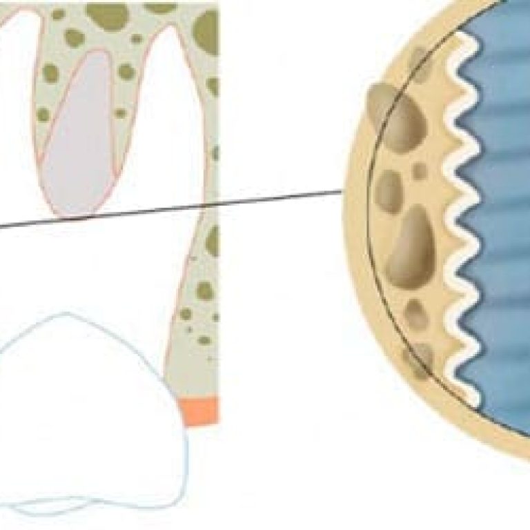 Osteointegrarea implanturilor dentare
