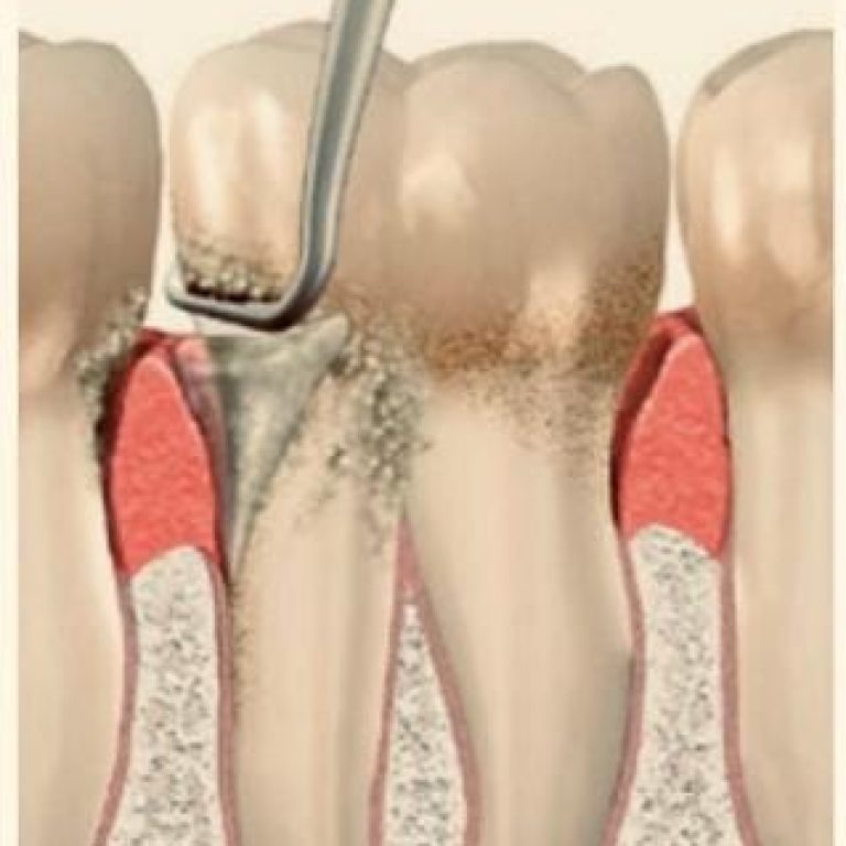 parodontoza_tratament