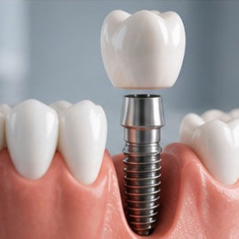 pret implant dentar bucuresti
