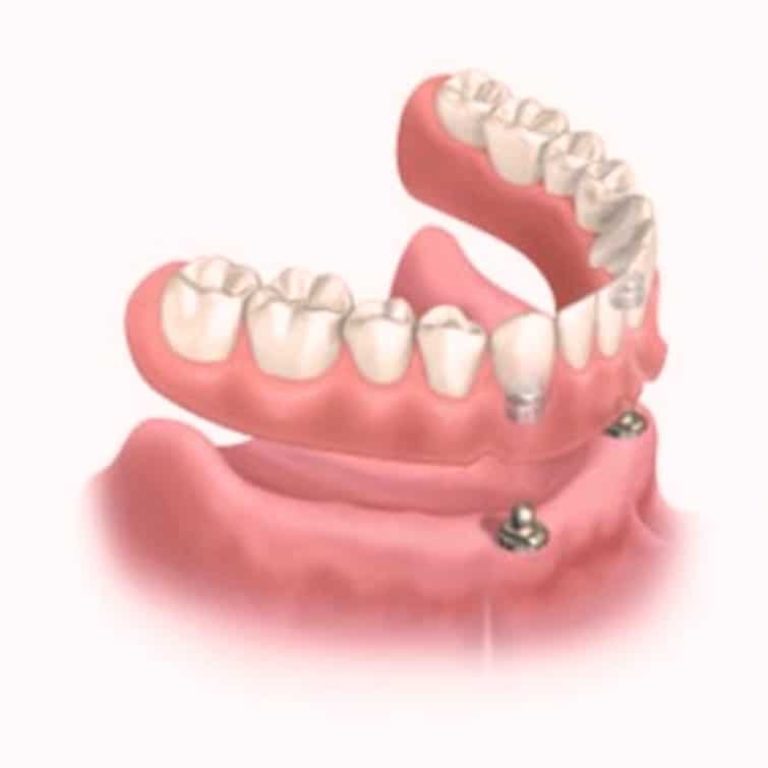 Beneficiile protezei dentare cu capse pe implant dentar