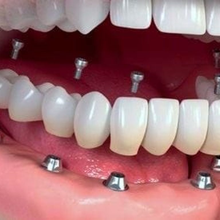 Proteza fixa pe implanturi dentare