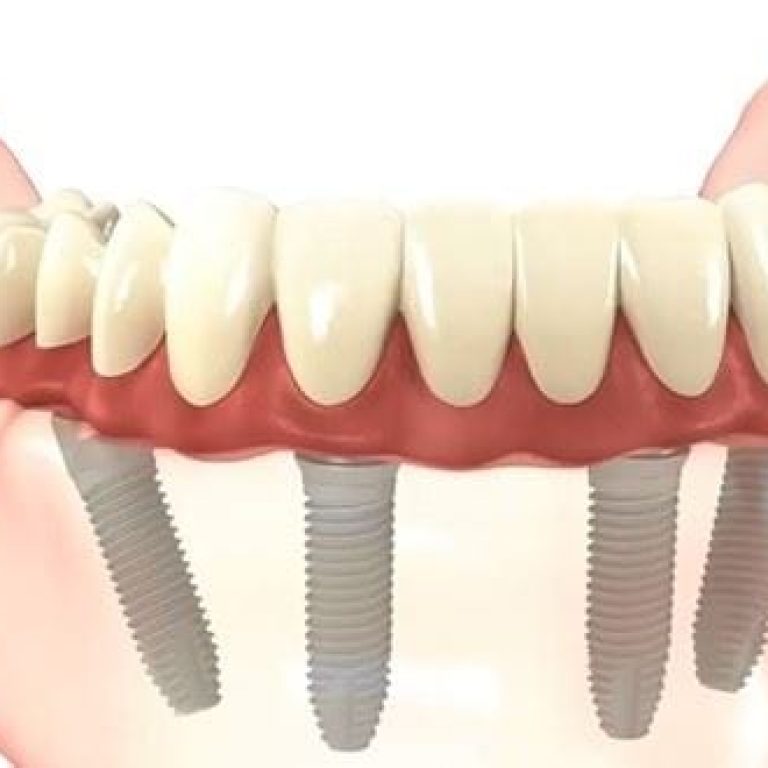 Proteza dentara pe implanturi: tipuri, caracteristici