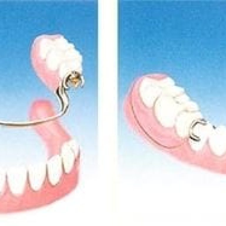 Proteza dentara mobila