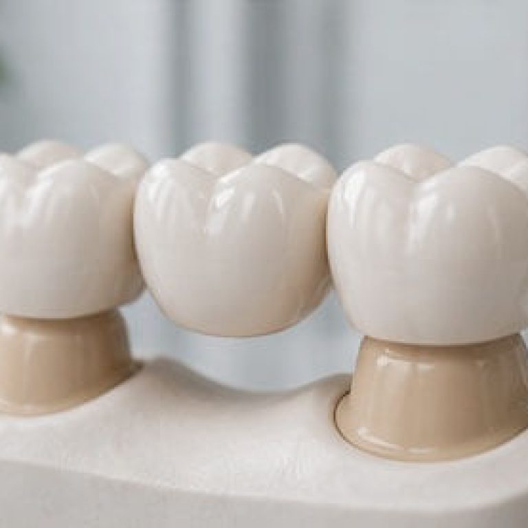 punte dentara pret tipuri si alternative