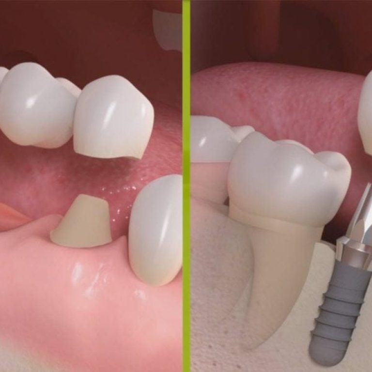 Inlocuirea dintilor: implant dentar sau punte dentara