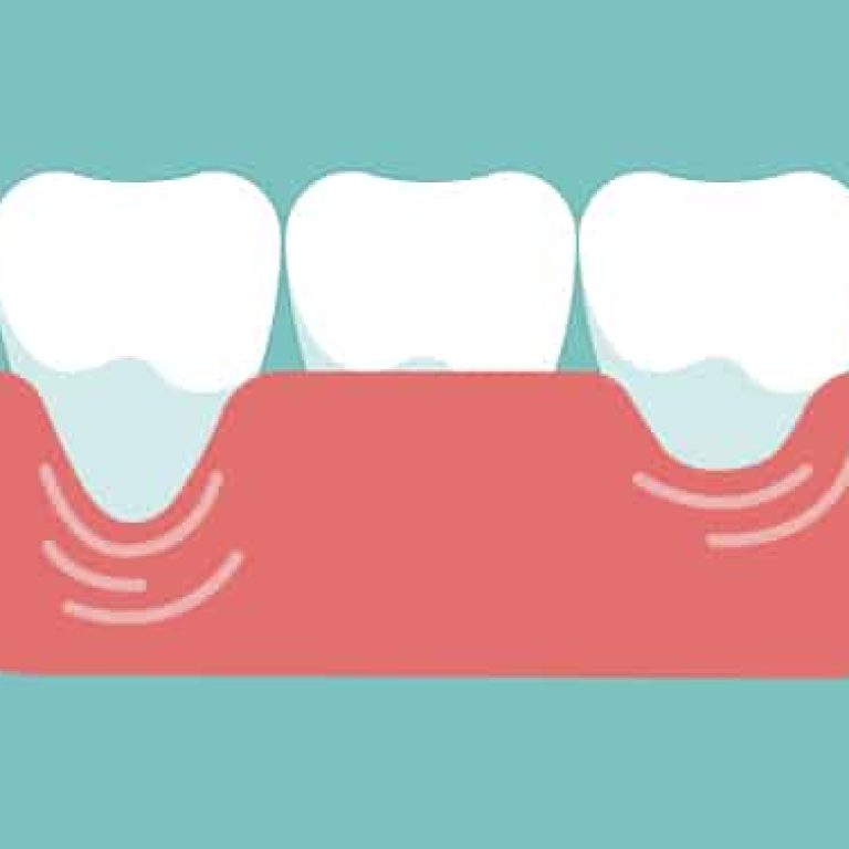 Retractia gingivala: cauze, simptome si tratament