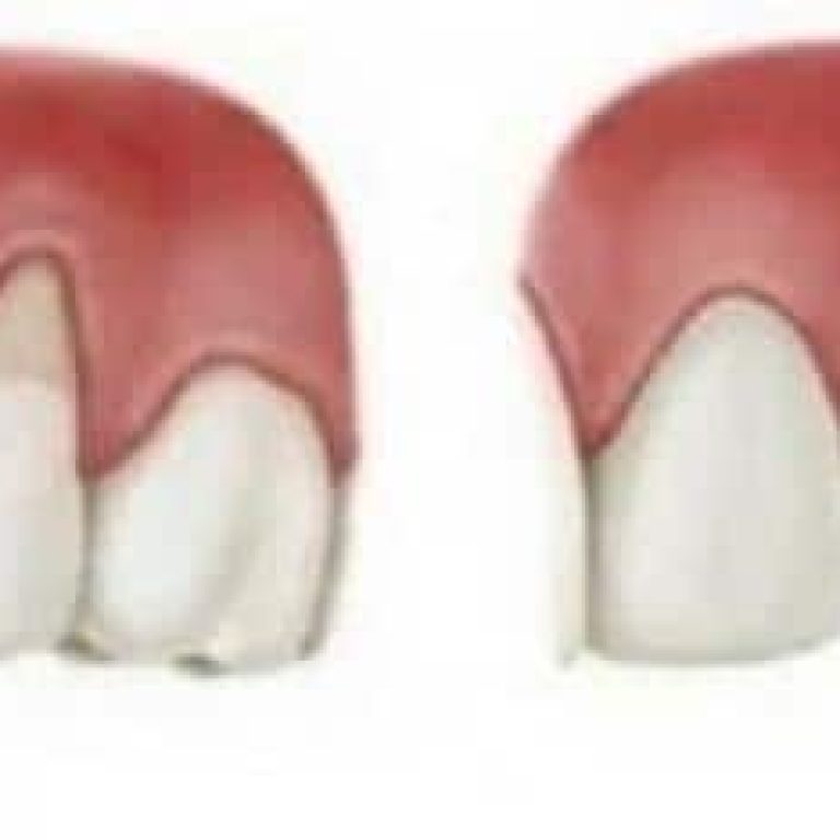 Tratament parodontoza