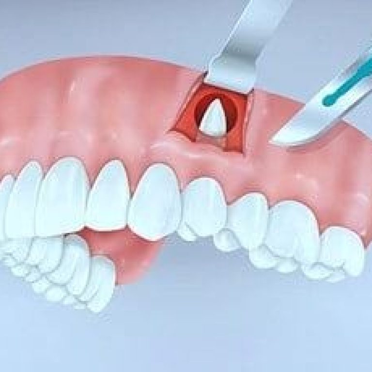 rezectie apicala doare