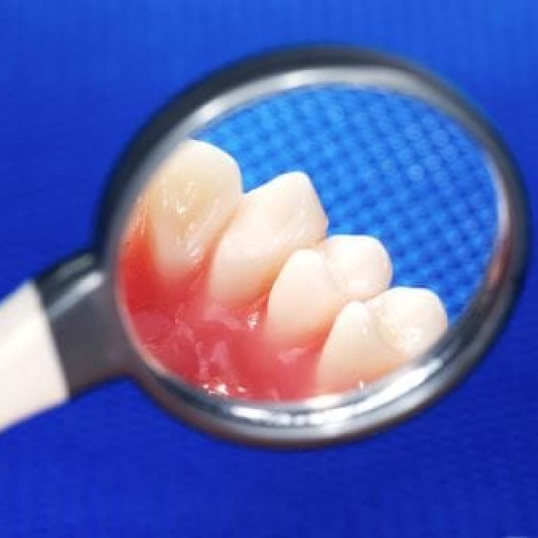sangerari gingivale