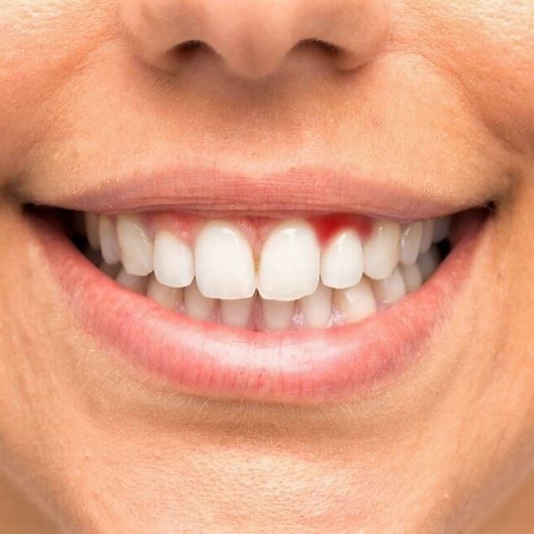 sangerare gingii cauze