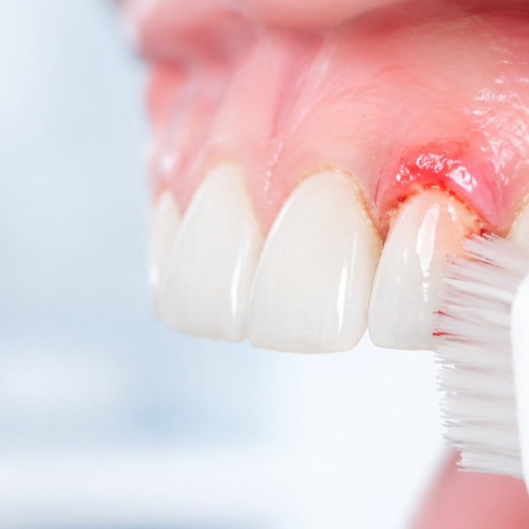 De ce sângerează gingiile la periaj și când trebuie să mergi la medic?