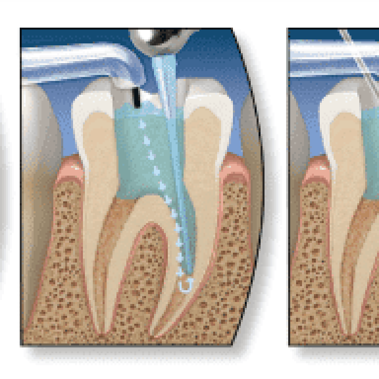 procedura endodontica