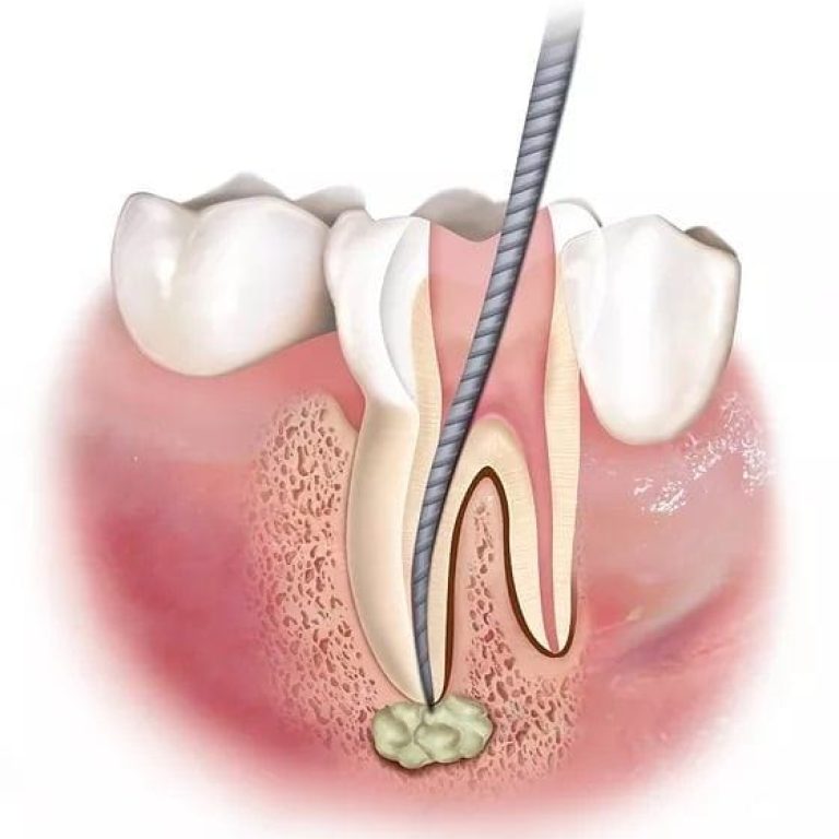 endodontie