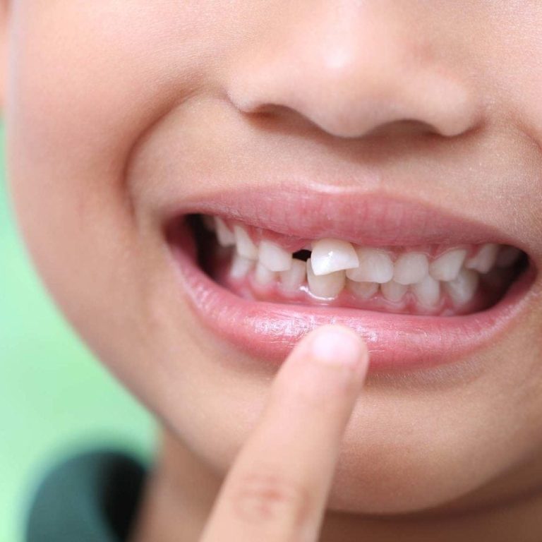 traumatism dentar copii